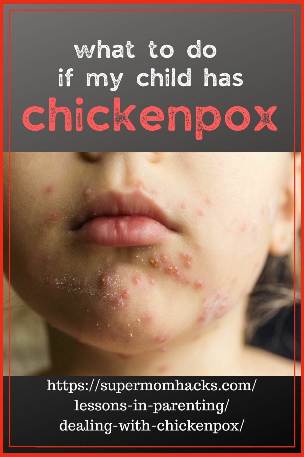 Dealing with chickenpox is never fun. But parents can ease their kids' suffering with these home remedies for chickenpox.