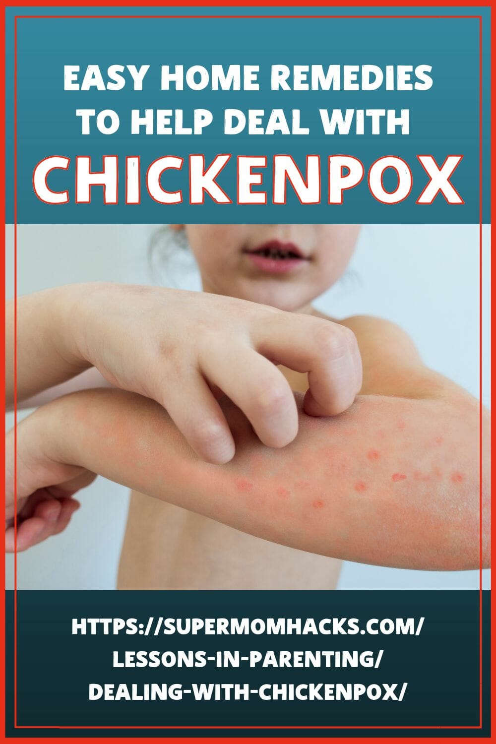 Dealing with Chickenpox (The Parent\'s Survival Guide)